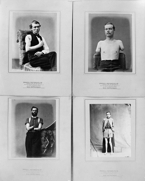 This series of photographs, compiled by the U.S. Surgeon General's Office, illustrates the different types of arm amputations.