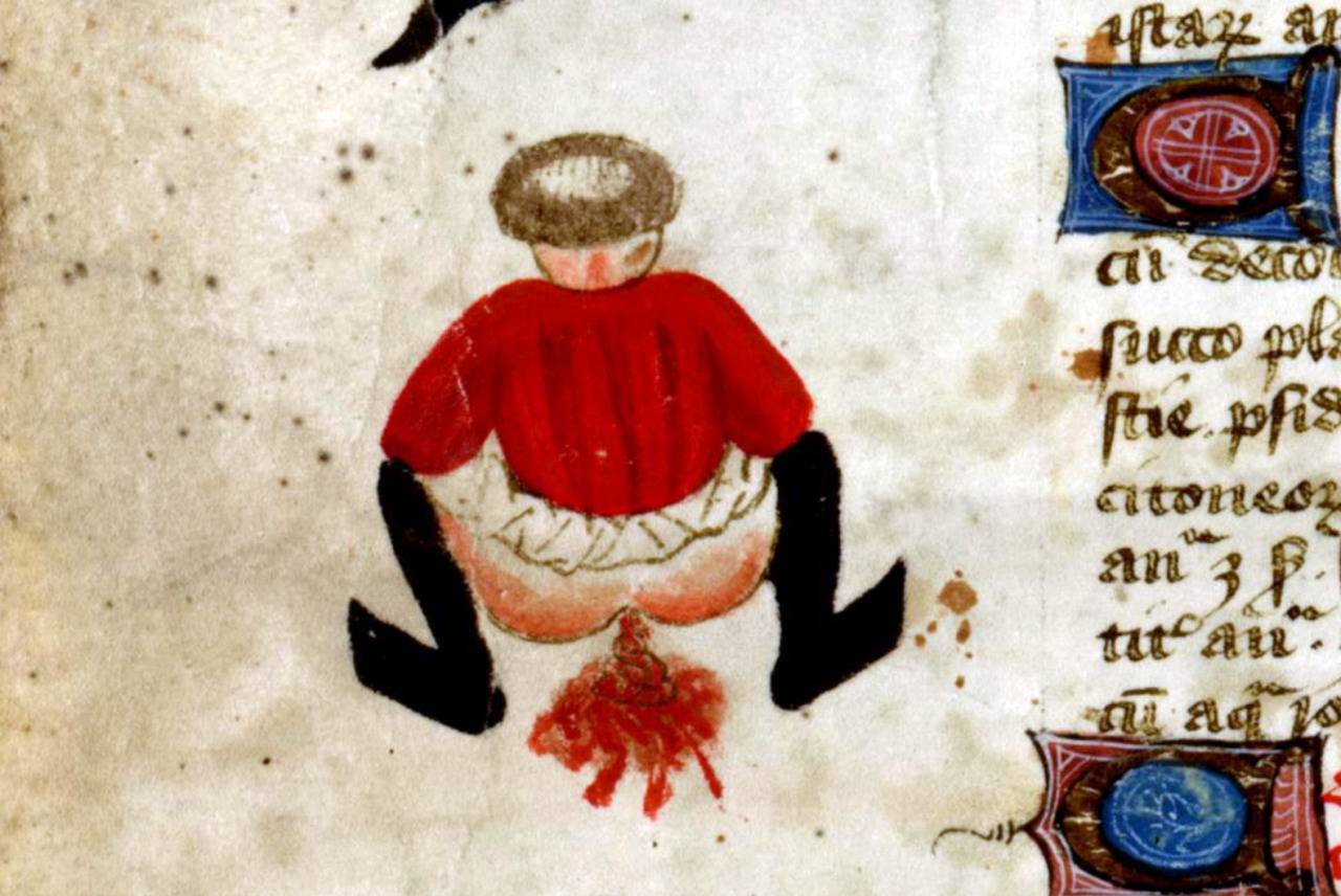 John Arderne, De arte phisicali et de cirurgia, England ca. 1425. Stockholm, Kungliga biblioteket, X 118