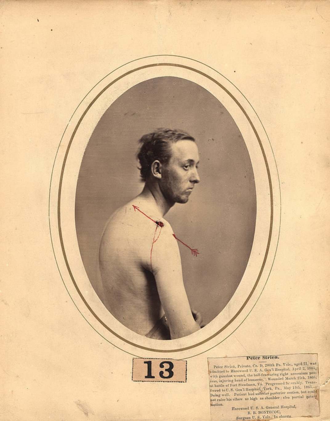 dr-reed-bontecou-s-stunning-pictures-of-wounded-civil-war-veterans