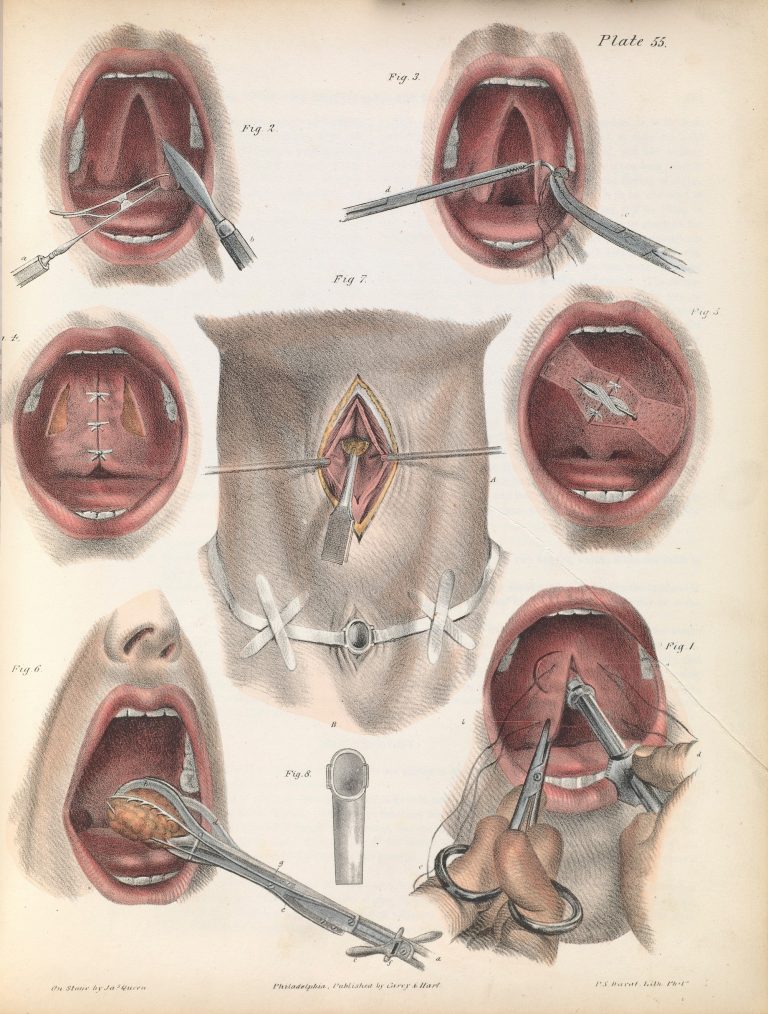 Plate-55-J.-Pancoast-A-treatise-on-operative-surgery-1846.-768x1014.jpg