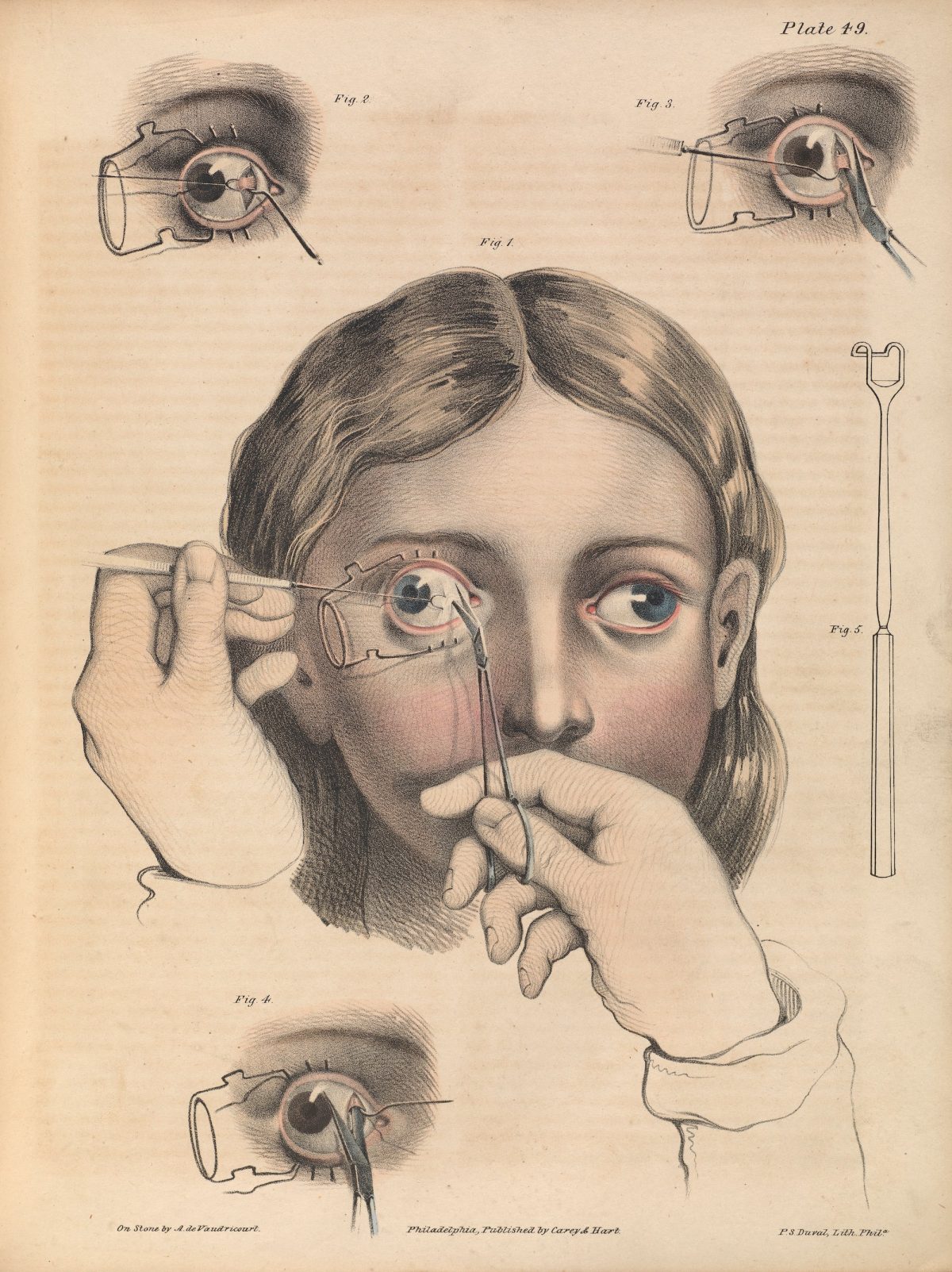 Plate XLIX. Surgery to correct strabismus, involving the division of the internal rectus of the right eye. Strabismus is the misalignment of the eyes.