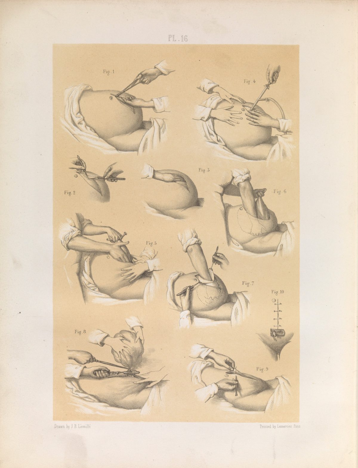 Plate 16. Various operative stages of the removal of a tumour from the uterus.