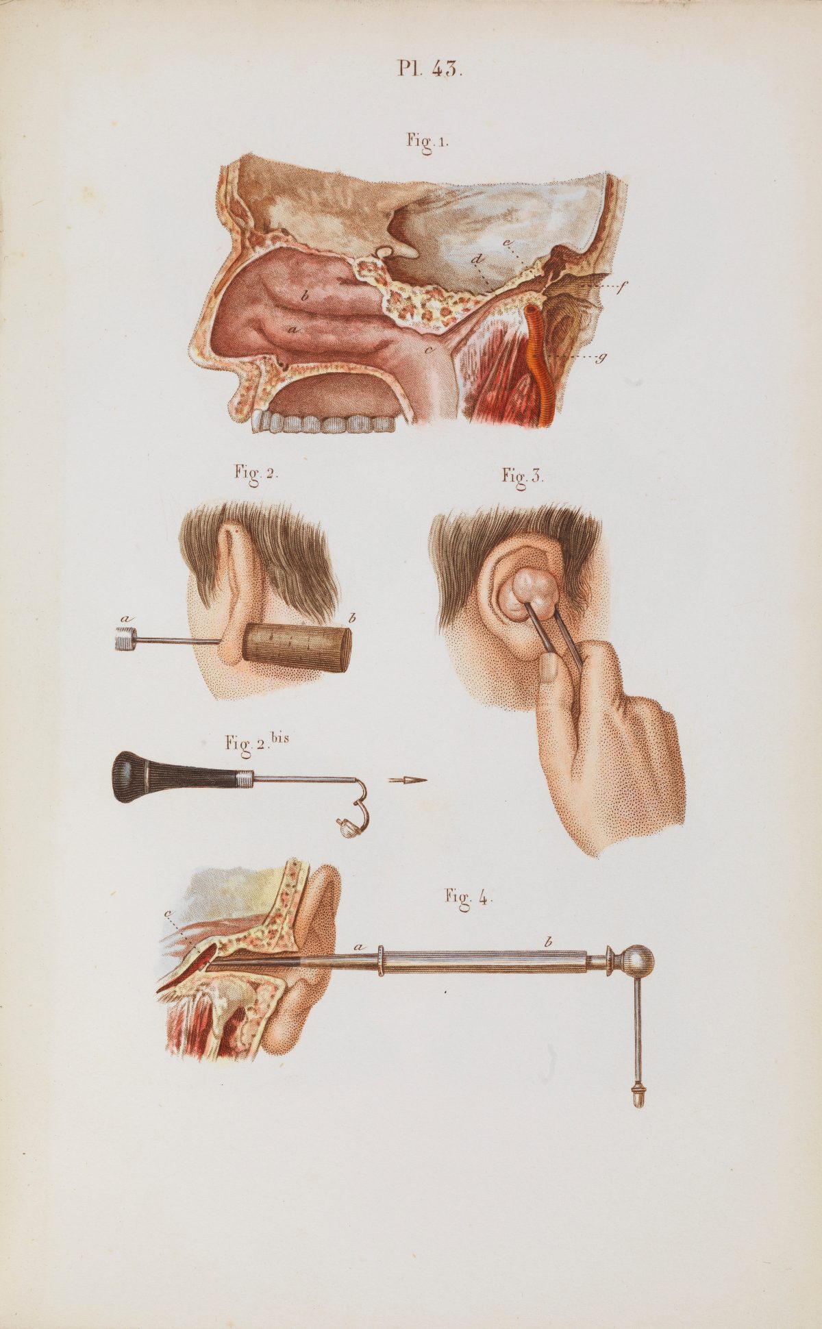 Plate 43, Illustration and anatomy of ear surgery.