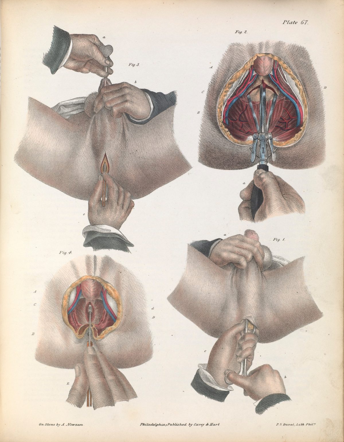 Plate LXVII. Surgical technique for lithotomy (the removal of a bladder stone). Bilateral and vesico-rectal operation.