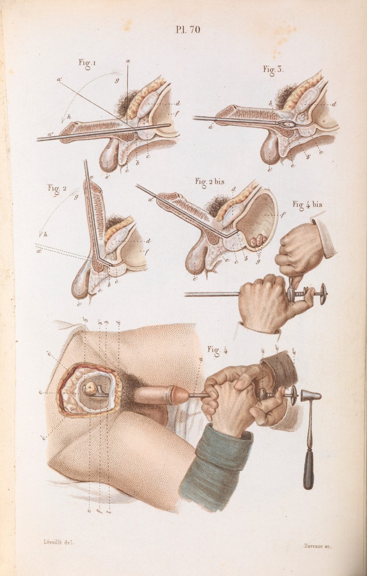 Plate 70, Surgical techniques for lithotripsy (the removal of bladder and kidney stones).
