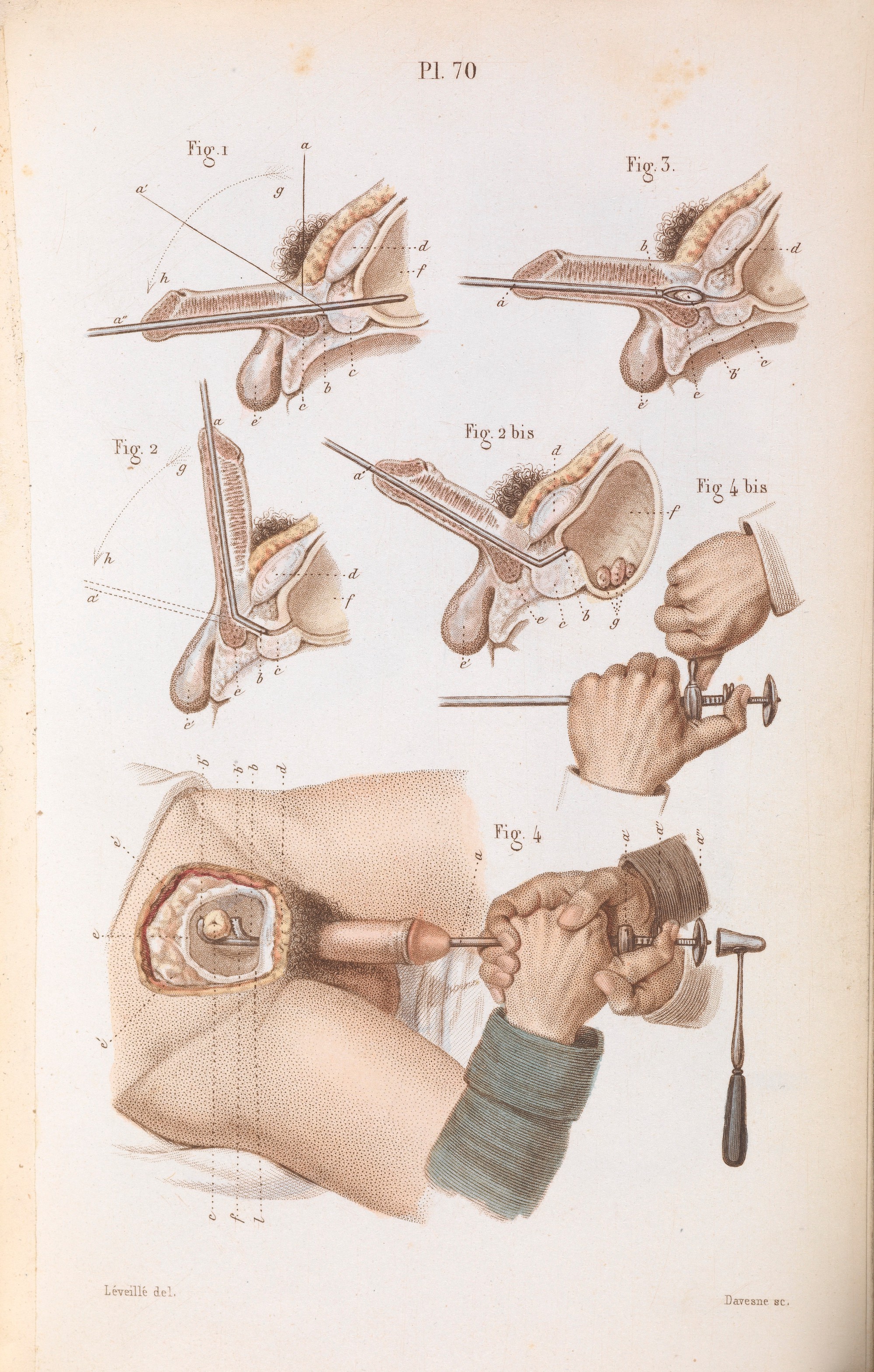 19th Century Illustrations For The Surgical Removal Of Unwanted Parts 