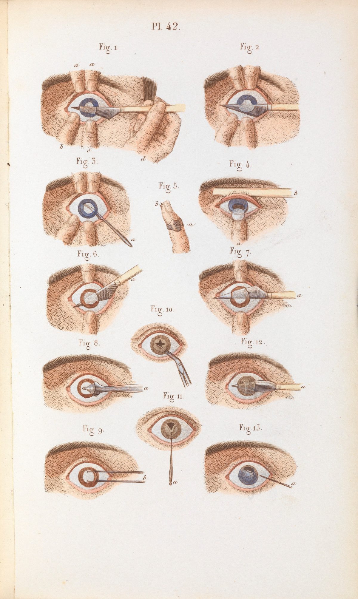 Plate 42, Techniques for the removal of cataracts.
