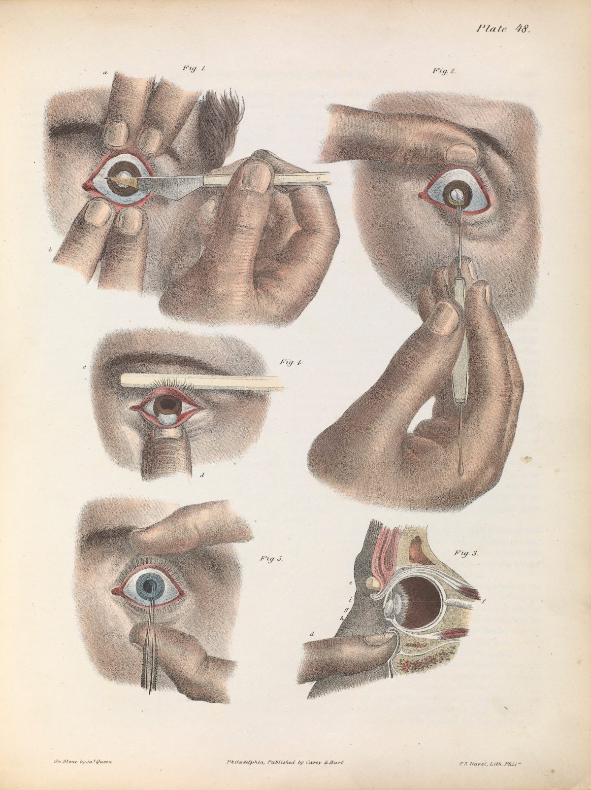 Plate XLVIII. Illustration of surgery on the eye for the removal of a cataract. Operation by extraction - inferior section of the cornea.