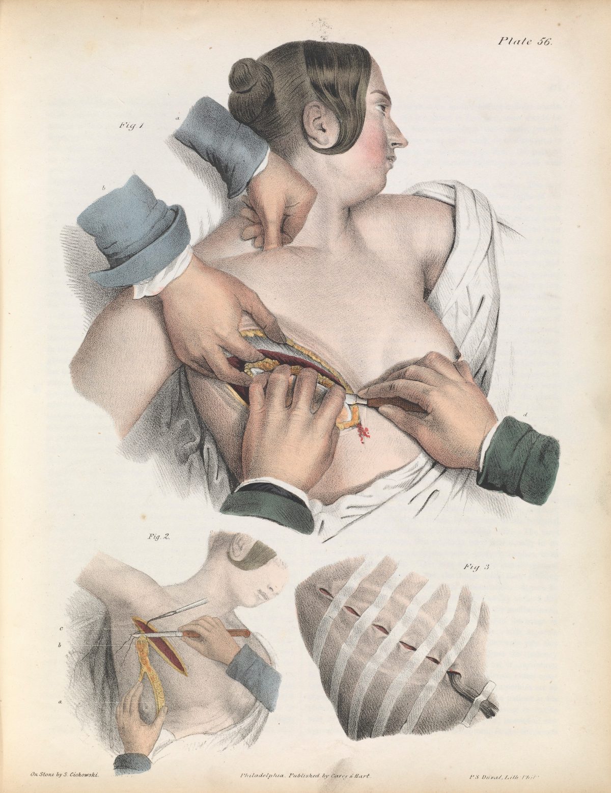 Plate LVI. Surgery for the removal of the mammary gland.