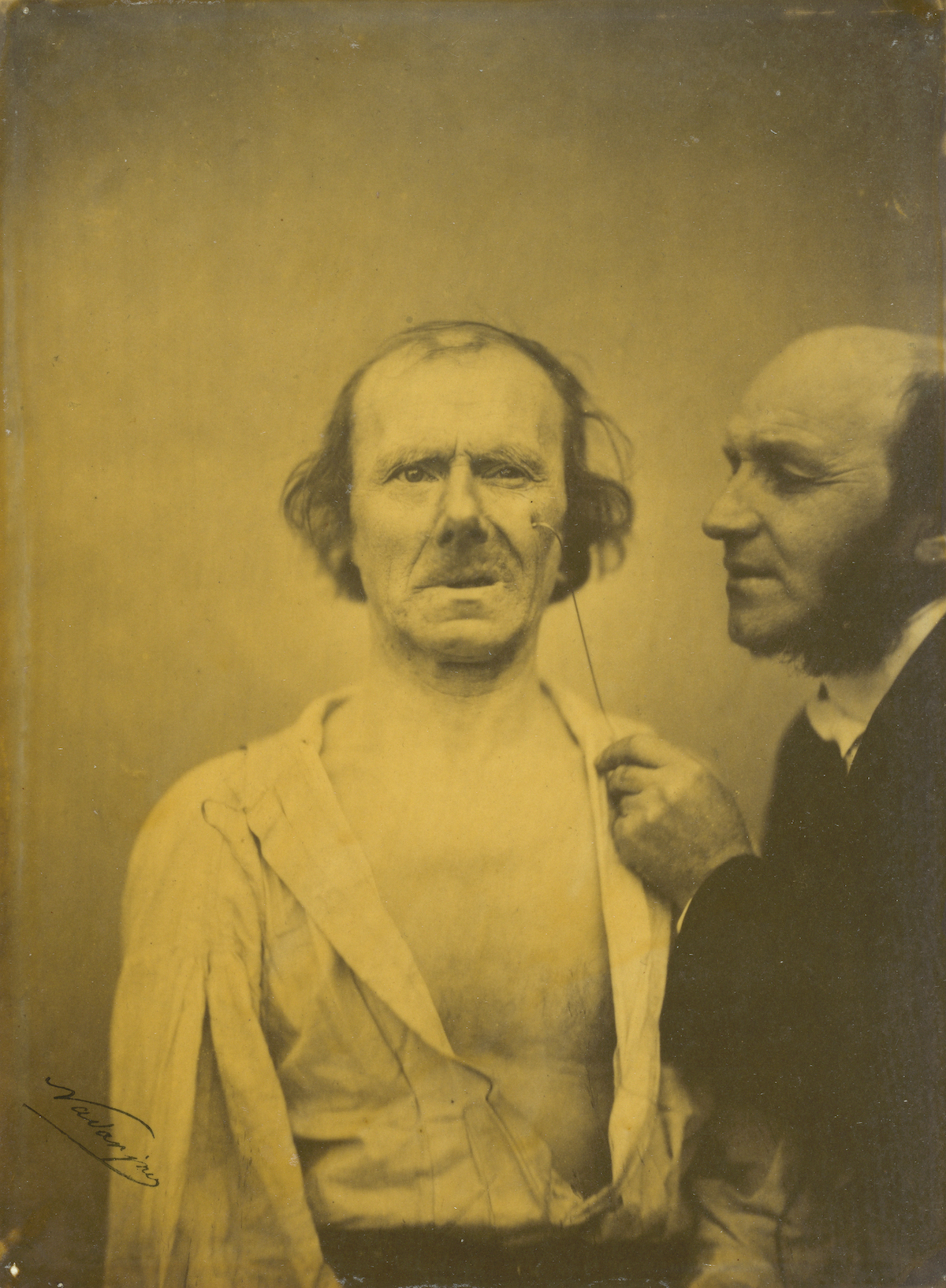 Experiments in facial expressions by Guillaume-Benjamin-Amand Duchenne de Boulogne