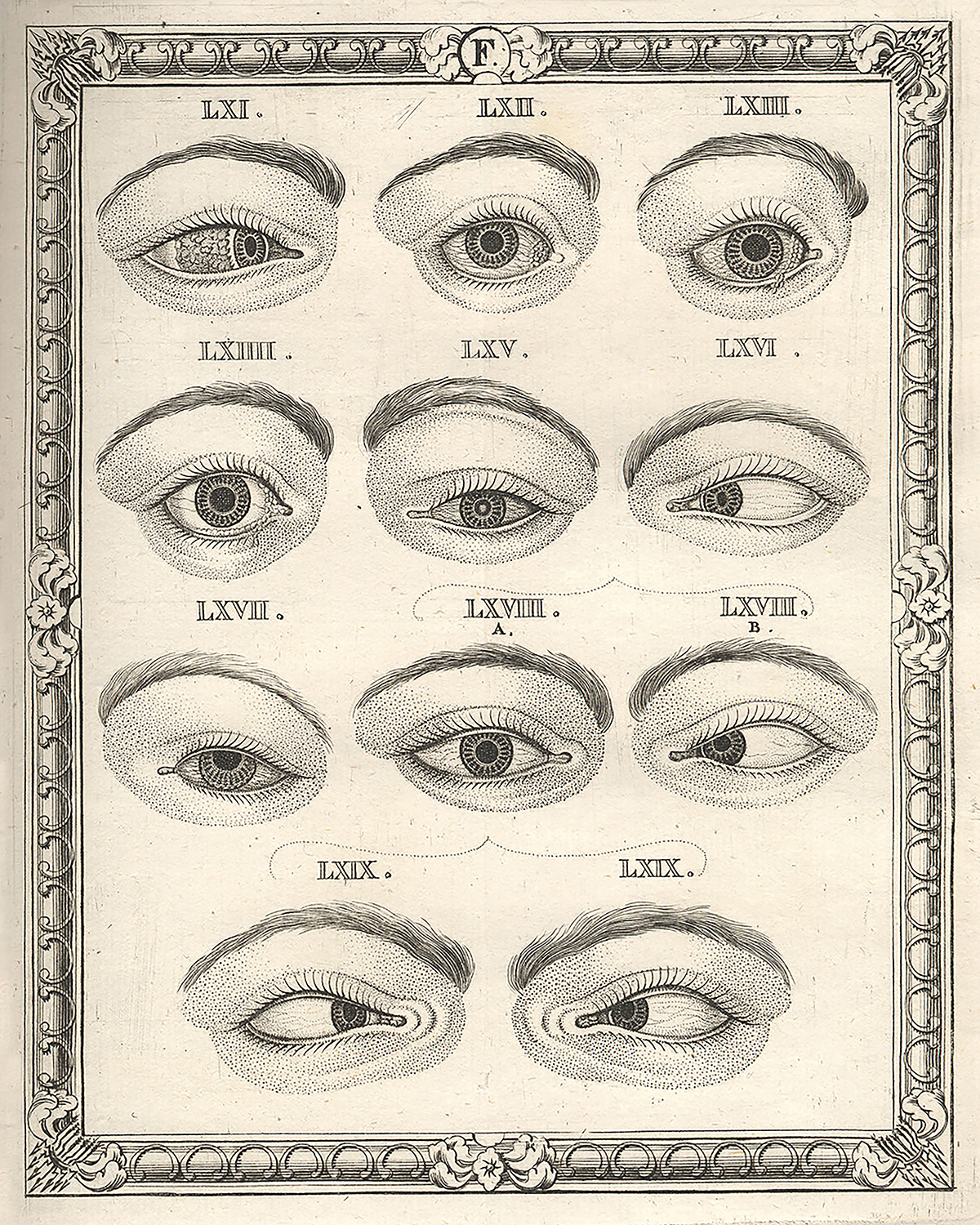 Diagram of diseases of the lens from Taylor's Atlas "Nova Nosographia Ophthalmica" (1766b). 